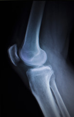 X-ray orthopedics scan of painful knee meniscus leg injury