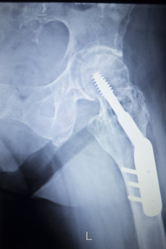 X-ray scan  image of hip joint replacement orthopedic implant