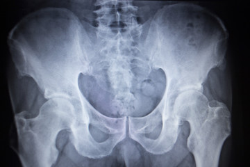 X-ray orthopedic scan  image of hip joints human skeleton
