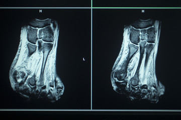 MRI scan test results foot toes injury