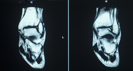 MRI scan test results ankle injury