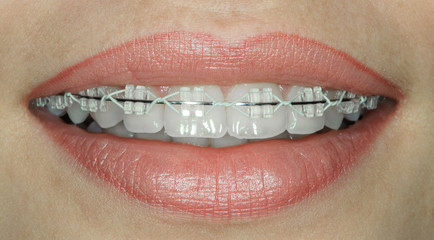 teeth with ceramic braces