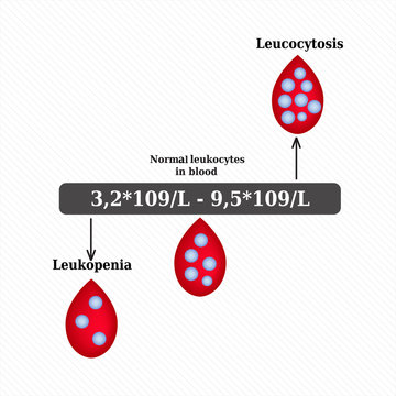 White blood cell count. Leukopenia. Leukocytosis. Infographics. Vector illustration