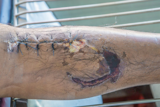 operation suture with a blue fiber at leg patient