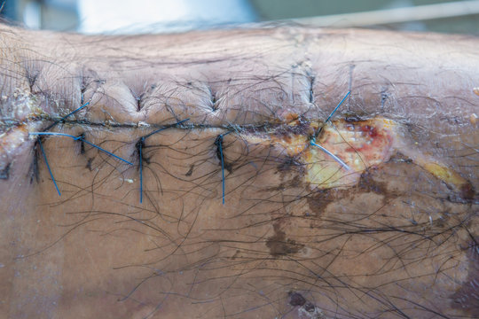 operation suture with a blue fiber at leg patient