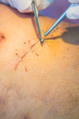 operation suture with a blue fiber at leg patient