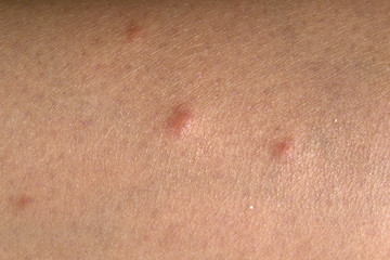 Fototapeta premium Human skin irritated after mosquito bites