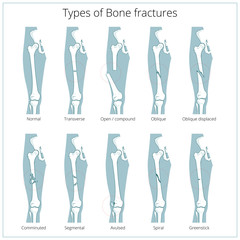 Types of bone fractures medical educational vector