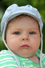 Baby mit Ekzem im Gesicht
