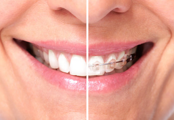 Healthy woman teeth.