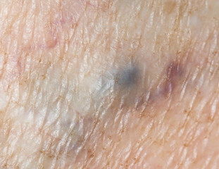 dilated veins on the skin of the legs as a background