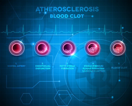 Artery anatomy and atherosclerosis on a abstract background