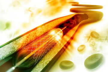 Stent angioplasty procedure with placing a balloon