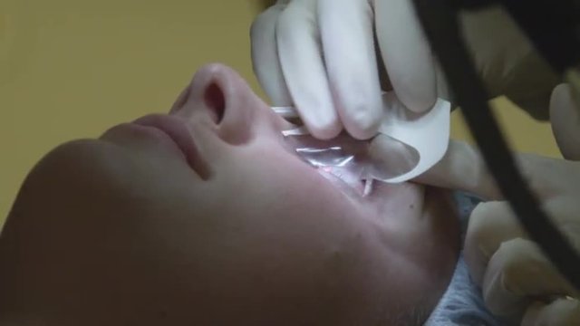 STEP 2 CLOSE UP: Opening an eye with the machine