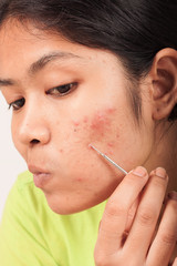 acne on  skin face women