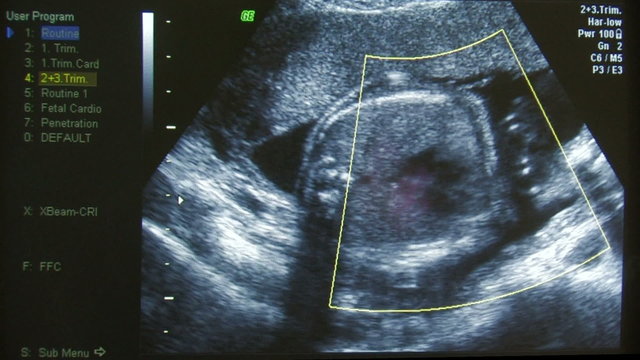 Ultrasonography fetus scan 2