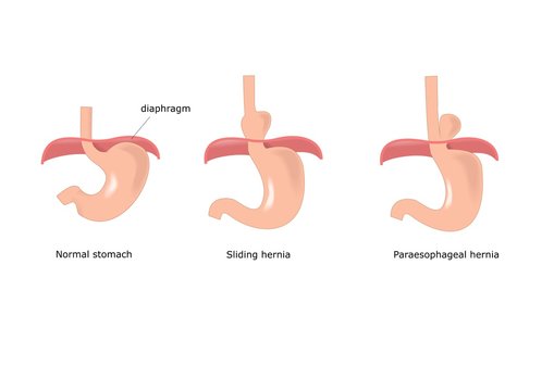 principali tipi di ernia esofagea