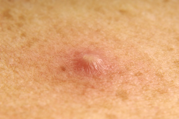 Fototapeta premium pimple of pus