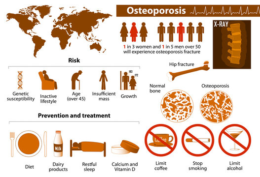 osteoporosis infographic