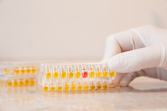 Laboratory doctor holding a urine test for Mycoplasma and Ureaplasma urealyticum, this is showing a positive result with these bacteria