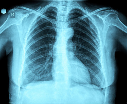 xray of chest