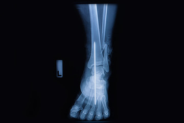 Fracture of the lower part of the fibula, front view X-ray