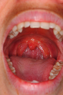 tonsil and gland in the throat