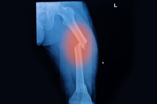 Fractured Femur, Broken leg x-rays image