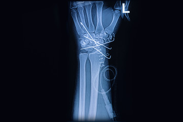 X-ray image of wrist joint, Showing radius fracture with k wire