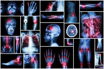 X-ray multiple disease ( stroke (CVA) , fracture , shoulder dislocation , bowel obstruction ,...
