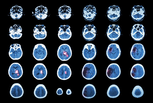 Hemorrhagic Stroke and Ischemic Stroke .  CT scan of brain : intracerebral hemorrhage ( 3 left column) , cerebral infarction ( 3 right column )) ( Medical and Science background )