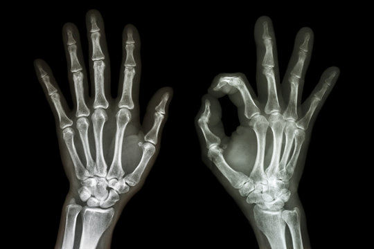 X-ray both hands with OK sign