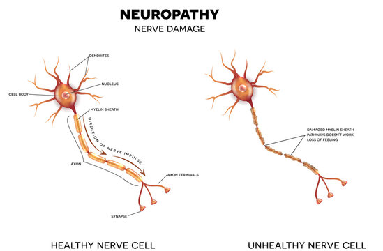 Neuropathy, nerve damage