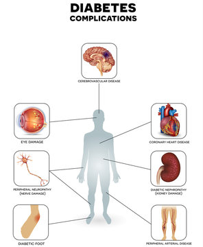 Diabetes complications, affected organs. Diabetes affects nerves, kidneys, eyes, vessels, heart and skin.