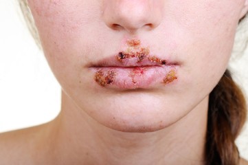 Close up of lips affected by herpes/Close up of lips affected by virus herpes; suffering; pain
