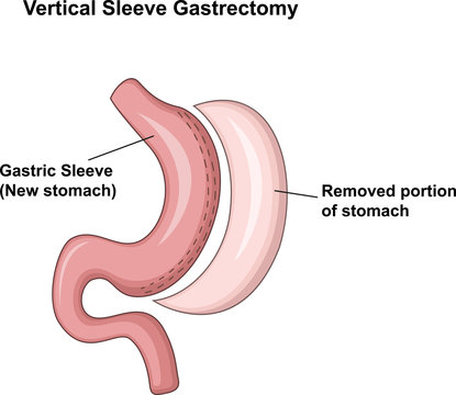 Illustration of Vertical Sleeve Gastrectomy (VSG)