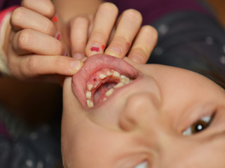 Young caucasian girl after dental extraction