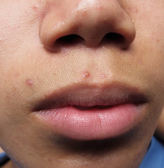 Fototapeta premium Pimples and acne on the face of an Asian teenager.