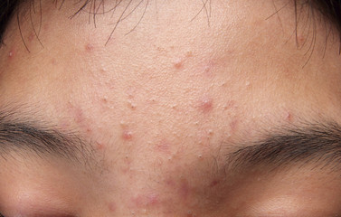 Pimples and acne on the forehead of an Asian teenager.