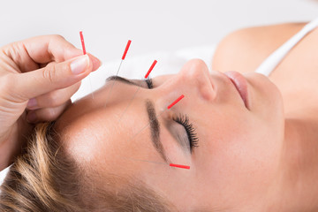 Hand Performing Acupuncture Therapy On Head - obrazy, fototapety, plakaty