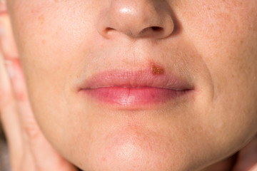 Herpes labialis: oral herpes on upper lip of a woman