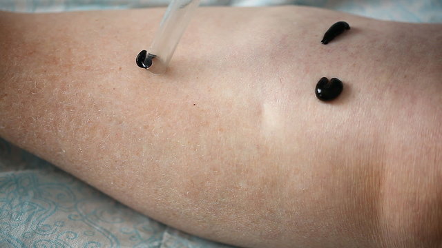 the procedure hirudotherapy