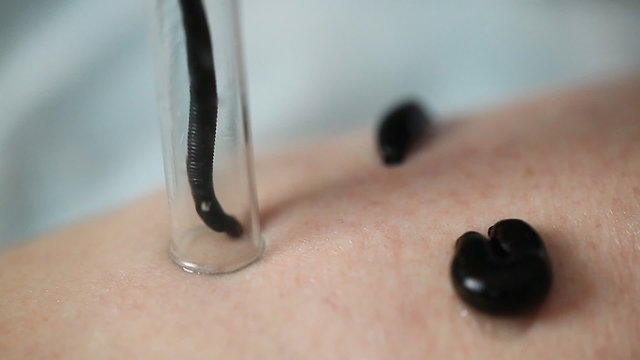 the procedure hirudotherapy
