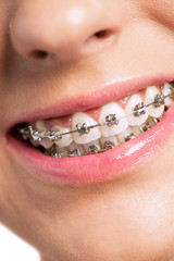 Fototapeta premium Happy smiling healty woman with braces