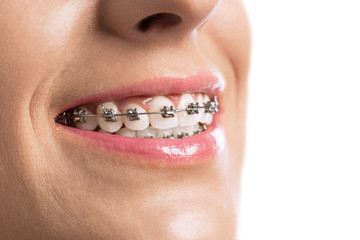 Naklejka premium Close up of braces girls teeth
