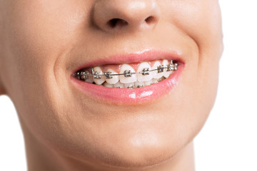 Smiling female mouth with braces on her teeth