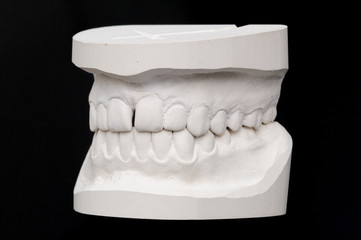 Gebiss Abformung Seite rechts