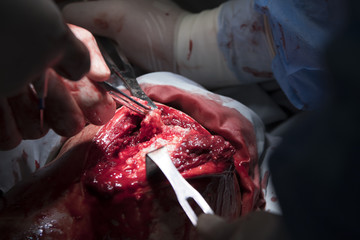 Cartilage removal