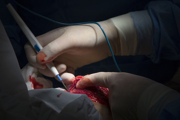 Electrosurgery close-up