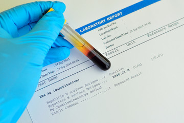 Blood sample with hepatitis B surface antigen (HBs Ag) testing result